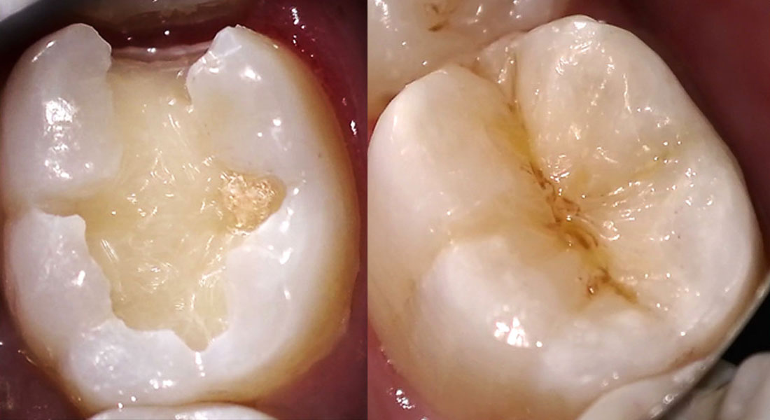 Composite Restoration