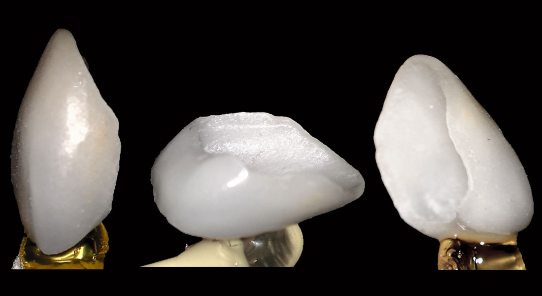 Dental Venner