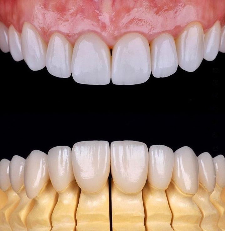 Full Mouth Rehabilitation