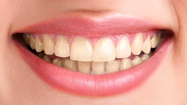 Teeth whitening