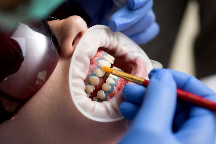 Teeth whitening